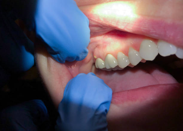 Best Emergency Tooth Extraction in Rocky Mount, VA