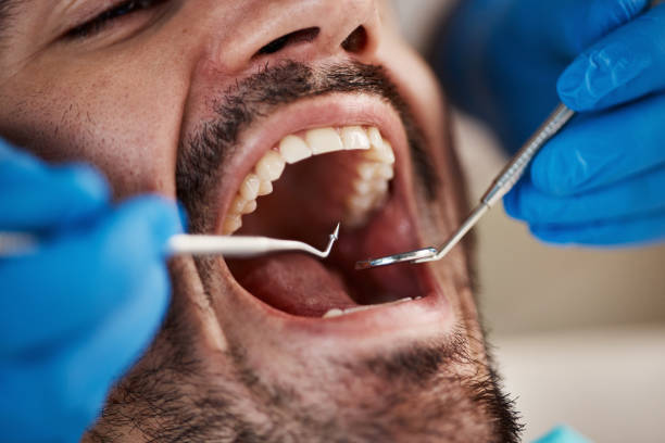 Best Emergency Wisdom Teeth Removal in Rocky Mount, VA