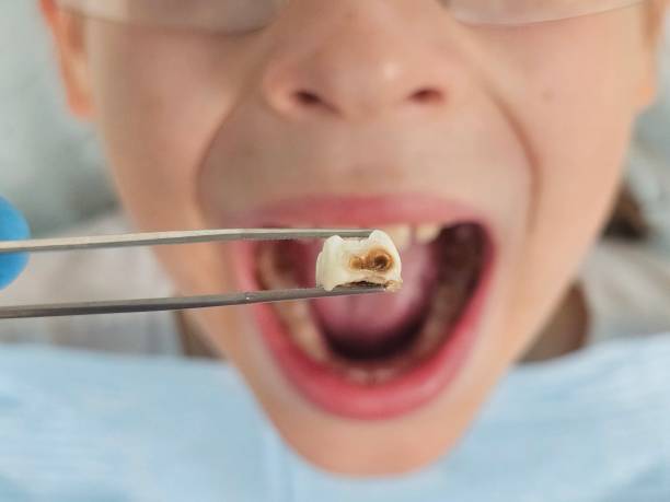 Best Emergency Treatment for Toothache in Rocky Mount, VA